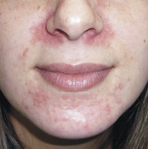 oxyhives skin rash on face