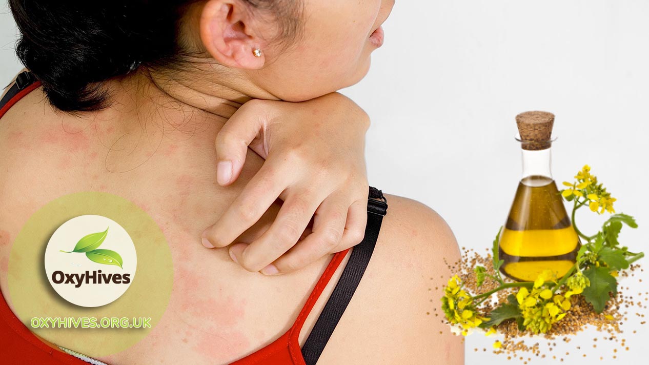 Essential oils to fight hives