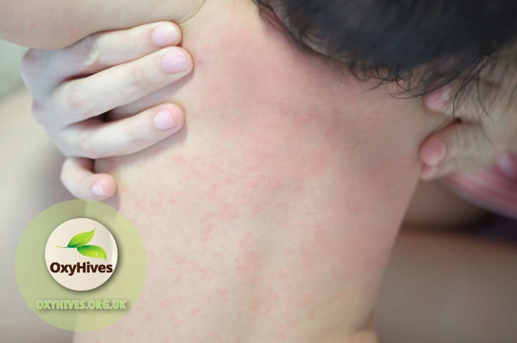 how-to-treat-urticaria-in-children-oxyhives-uk